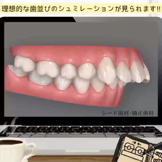#歯科矯正 #シード歯科　#矯正

こんにちは☺︎
シード歯科・矯正歯科です

当院が取り入れております、マウスピース矯正の
「インビザライン」では治療開始前に理想的な歯並びへのシュミレーションを実際に見ていただき、患者様にご納得いただけるよう丁寧なカウンセリング行っております。

ぜひお気軽にご相談いただければと思います😌

治療費
ラミネートべニア
33万円〜66万/前歯6本
インレー11万円～16.5万円
クラウン16.5万円～33万円
ワイヤー矯正、部分矯正
33万円~165万円
マウスピース矯正33万円〜165万円
その他検査費用3.3万円~16.5万円

＊本数に応じて費用が変わります。
一般的なケースでは、ラミネートべニア前歯6本と全体のマウスピース矯正で合計110万円です。
難しいケースは、220万円程度です。

その他再診料、処置料1,100円〜11,000円かかる場合がございます。

⚠️リスク
噛み合わせの不調、顎関節症状、歯がしみる、セラミックの脱離、チッピング等、稀に生じる場合がございます。

*****************************

⚪︎シード歯科・矯正歯科 東京
( Tel ) 03-6265-1732
( mail ) miyabi.dc@gmail.com

 @seed_dental_tokyo 

*****************************

ぜひフォローよろしくお願いします✨️
@seed_dental_nanto
@seed_dental_takaoka 

#矯正歯科 #マウスピース矯正 #部分矯正 #ワイヤー矯正 
#インビザライン#歯列矯正 #審美歯科
#審美補綴
#自由診療専門 #審美歯科治療
#ホワイトニング #ジルコニア #予防歯科
#お求めやすい価格 #美しい歯 #美容歯科