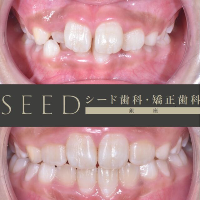 #シード歯科 #矯正歯科 #小児矯正

こんにちは☺︎
シード歯科・矯正歯科です

本日は小児矯正の症例になります。
歯が並ぶための顎の大きさや歯の大きさにより、ガタガタになってしまうことがあります。

このままで大丈夫なのか、、、
心配になりますよね。

歯医者さんにて検診を受けていただくのが
大切な歯を守っていくことに繋がりますのでぜひお気軽にお問い合わせ、ご相談ください!

当院では無料相談を行っておりますので、
どんなことを行うのか、どんな状態で治療が必要なのかを専門の先生にしっかり診てもらうことができます 𓂃꙳⋆

別投稿にて小児矯正について記載してありますのでぜひ参考までにご覧ください😊

治療費
ラミネートべニア
33万円〜66万/前歯6本
インレー11万円～16.5万円
クラウン16.5万円～33万円
ワイヤー矯正、部分矯正
33万円~165万円
マウスピース矯正33万円〜165万円
その他検査費用3.3万円~16.5万円

＊本数に応じて費用が変わります。
一般的なケースでは、ラミネートべニア前歯6本と全体のマウスピース矯正で合計110万円です。
難しいケースは、220万円程度です。

その他再診料、処置料1,100円〜11,000円かかる場合がございます。
⚠️リスク
噛み合わせの不調、顎関節症状、歯がしみる、セラミックの脱離、チッピング等、稀に生じる場合がございます。

*****************************

⚪︎シード歯科・矯正歯科 東京
( Tel ) 03-6265-1732
( mail ) miyabi.dc@gmail.com

 @seed_dental_tokyo 

*****************************

ぜひフォローよろしくお願いします✨️
@seed_dental_nanto
@seed_dental_takaoka 

#矯正歯科 #マウスピース矯正 #部分矯正 #ワイヤー矯正 #プレオルソ
#インビザライン#歯列矯正 #審美歯科
#審美補綴
#自由診療専門 #審美歯科治療
#ホワイトニング #ジルコニア #予防歯科#美容歯科