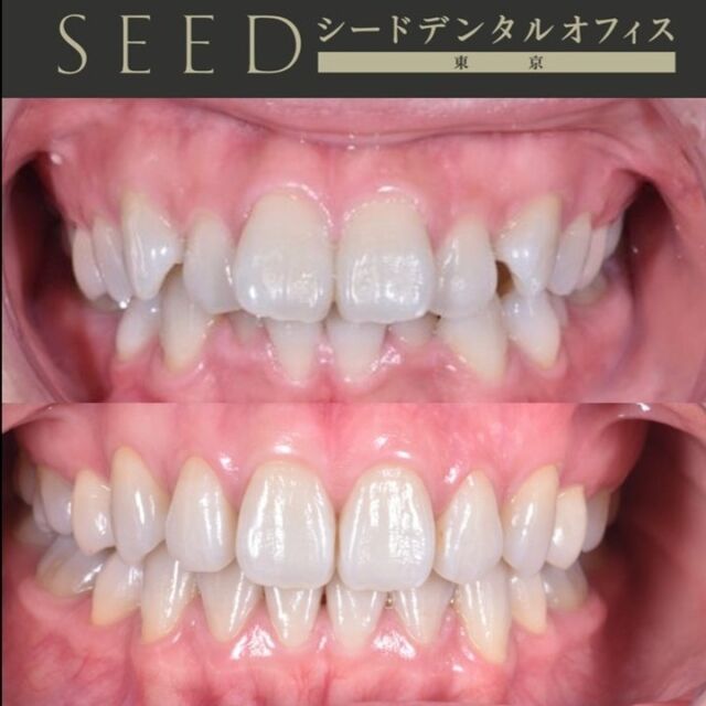 #シード歯科　#矯正

こんにちは☺︎
シード歯科・矯正歯科です

本日はマウスピース矯正の
『インビザライン』症例でございます。

上の写真と比べて、下の写真は特に気になる
前歯のがたつきが綺麗になっているのが分かります！

歯並びが綺麗になると見た目だけでなく、
清掃性も良くなるので歯ブラシが行き届きやすくなり虫歯や歯周病のリスクも減らせます✨

マスク生活もそろそろ終わっていく兆しが見えますね♪
これを機に透明で目ただないマウスピース矯正はいかがでしょうか？

ぜひお気軽にご相談いただければと思います😌

治療費
ラミネートべニア
33万円〜66万/前歯6本
インレー11万円～16.5万円
クラウン16.5万円～33万円
ワイヤー矯正、部分矯正
33万円~165万円
マウスピース矯正33万円〜165万円
その他検査費用3.3万円~16.5万円

＊本数に応じて費用が変わります。
一般的なケースでは、ラミネートべニア前歯6本と全体のマウスピース矯正で合計110万円です。
難しいケースは、220万円程度です。

その他再診料、処置料1,100円〜11,000円かかる場合がございます。

⚠️リスク
噛み合わせの不調、顎関節症状、歯がしみる、セラミックの脱離、チッピング等、稀に生じる場合がございます。

*****************************

⚪︎シード歯科・矯正歯科 東京
( Tel ) 03-6265-1732
( mail ) miyabi.dc@gmail.com

 @seed_dental_tokyo 

*****************************

ぜひフォローよろしくお願いします✨️
@seed_dental_nanto
@seed_dental_takaoka 

#矯正歯科 #マウスピース矯正 #部分矯正 #ワイヤー矯正 
#インビザライン#歯列矯正 #審美歯科
#審美補綴
#自由診療専門 #審美歯科治療
#ホワイトニング #ジルコニア #予防歯科
#お求めやすい価格 #美しい歯 #美容歯科