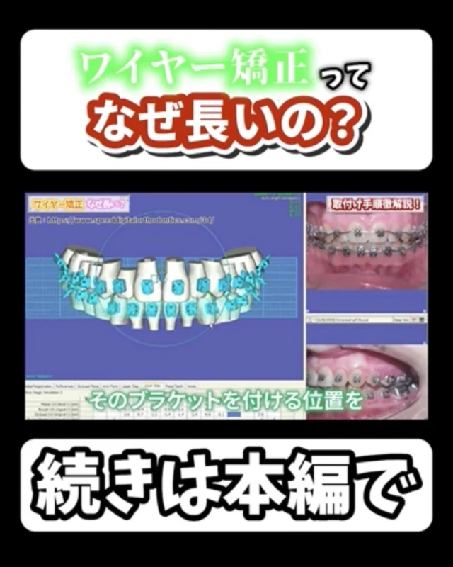 What is advantages and disadvantages of orthodontic treatment by using digitally 3D printed jig?

3D プリンターにより作成されたジグとブラケットのメリットとは？

本編はこちらから↓
https://youtu.be/JFRxU42e9WM

#誰でも出来るワイヤー矯正治療
#ワイヤーベンディングの要らない矯正治療